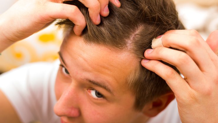 Hair Loss