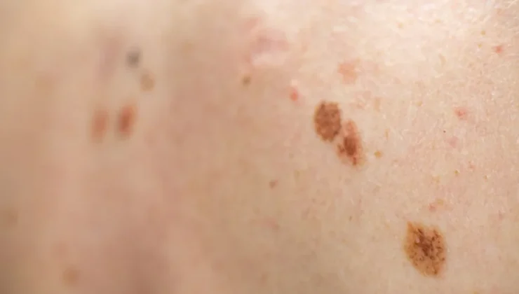 Mole Remover