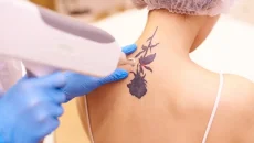 Tattoo Removal