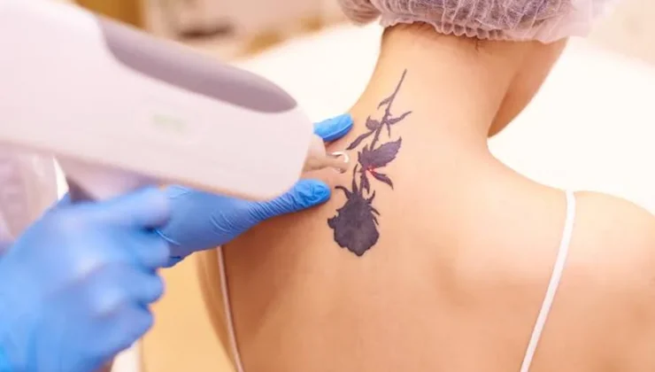 Tattoo Removal